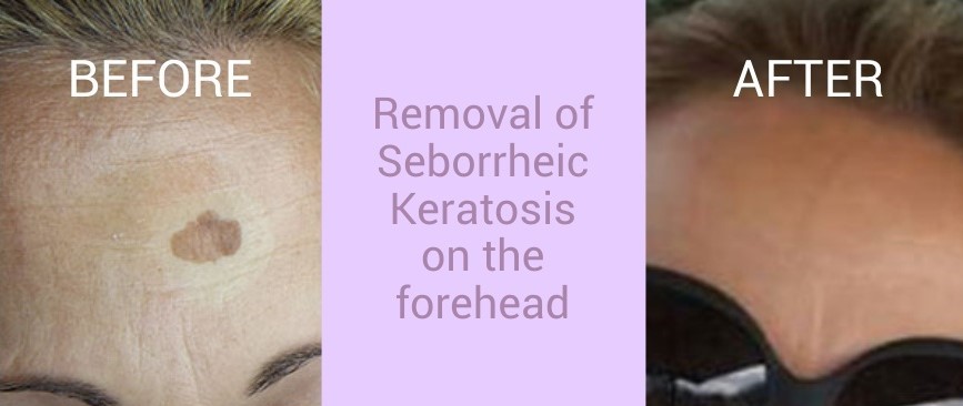 Updated Images BEFORE AND AFTER 001A