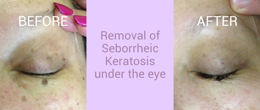 Updated Images BEFORE AND AFTER 002A