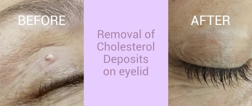 Updated Images BEFORE AND AFTER 005A