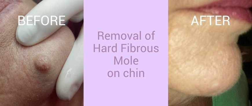 Updated Images BEFORE AND AFTER 006A